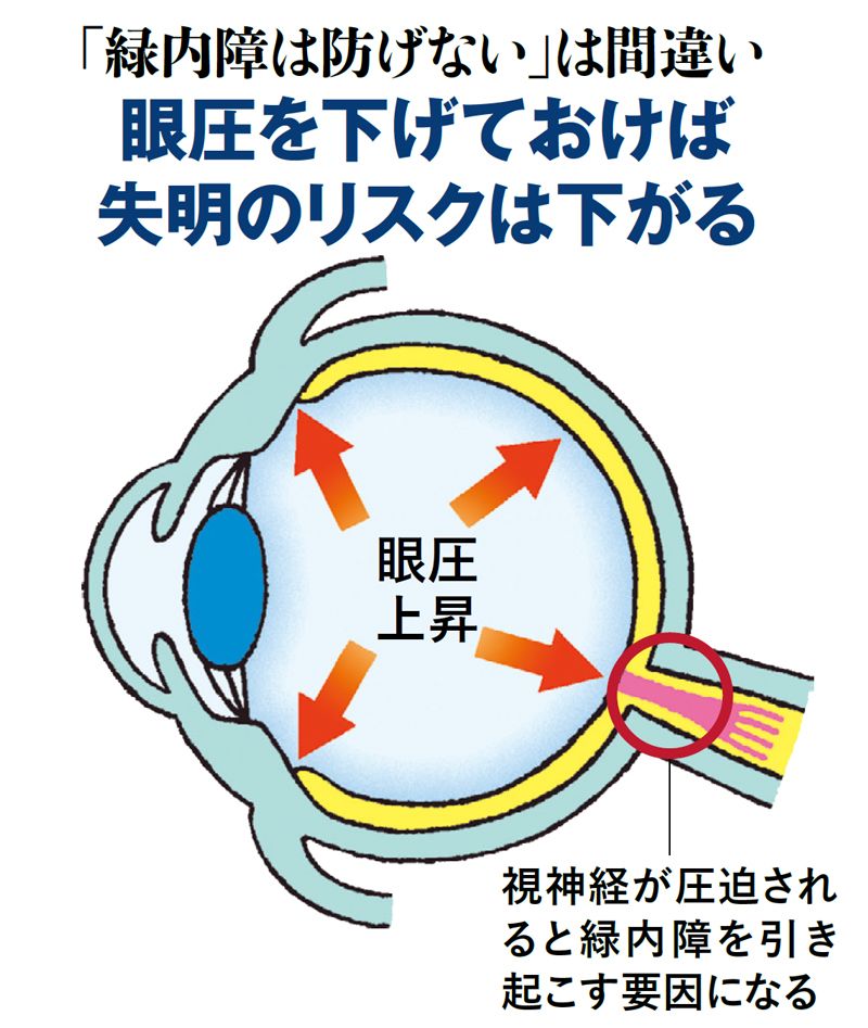 【図表】眼圧を下げておけば失明のリスクは下がる