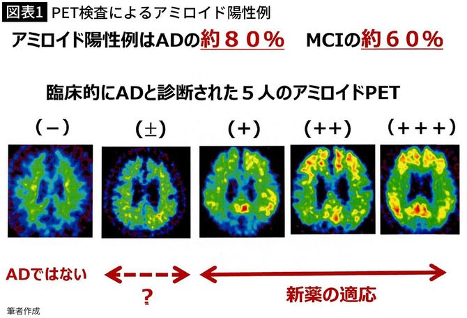 【図表1】PET検査によるアミロイド陽性例