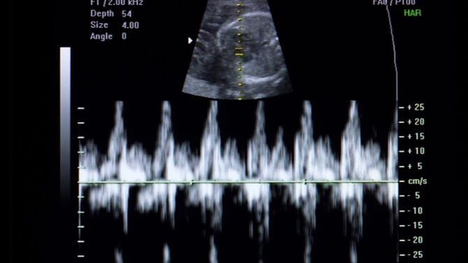 超音波検査の画像