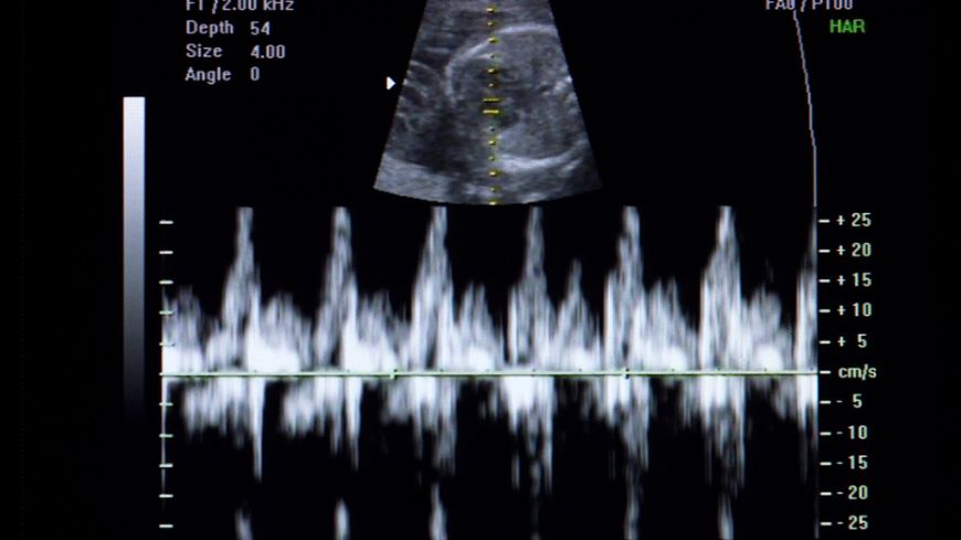 超音波検査の画像