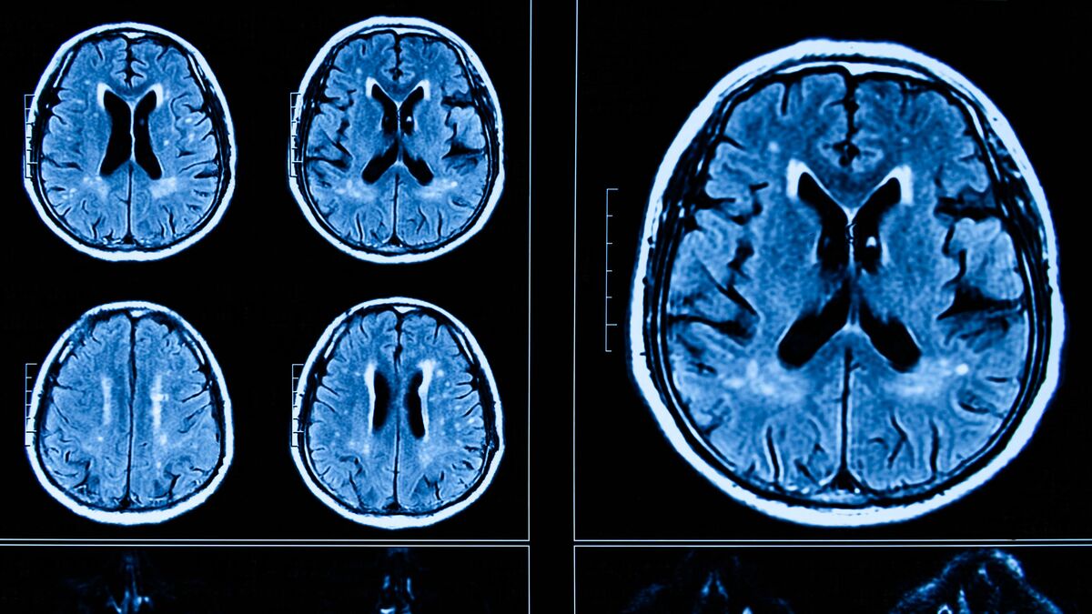 脳萎縮の原因は何ですか?