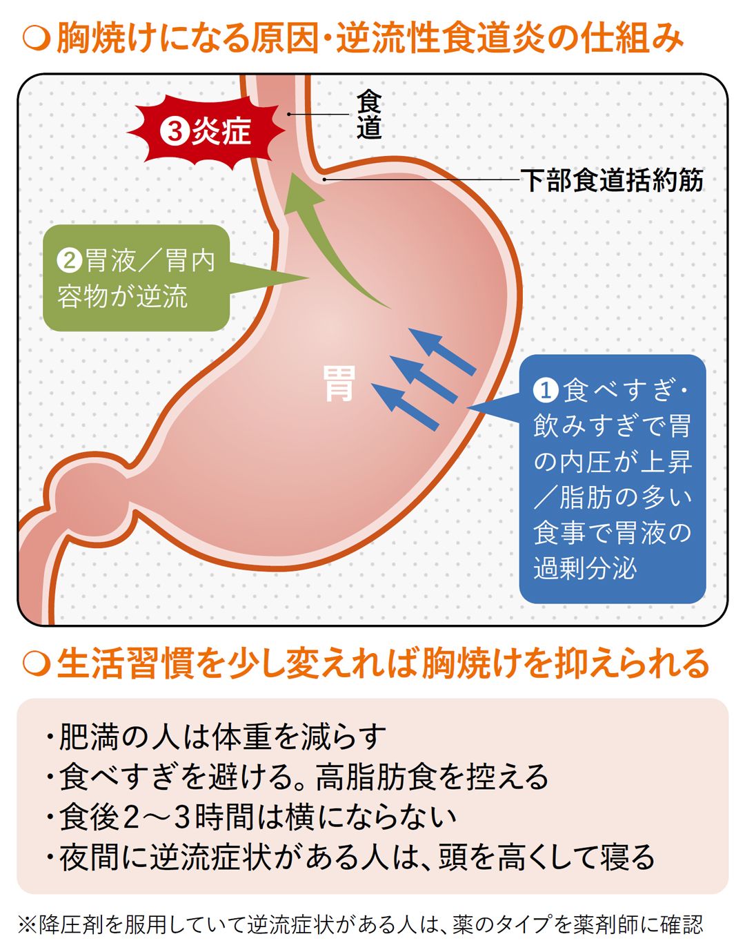 【図表】胸焼けになる原因・逆流性食道炎の仕組み