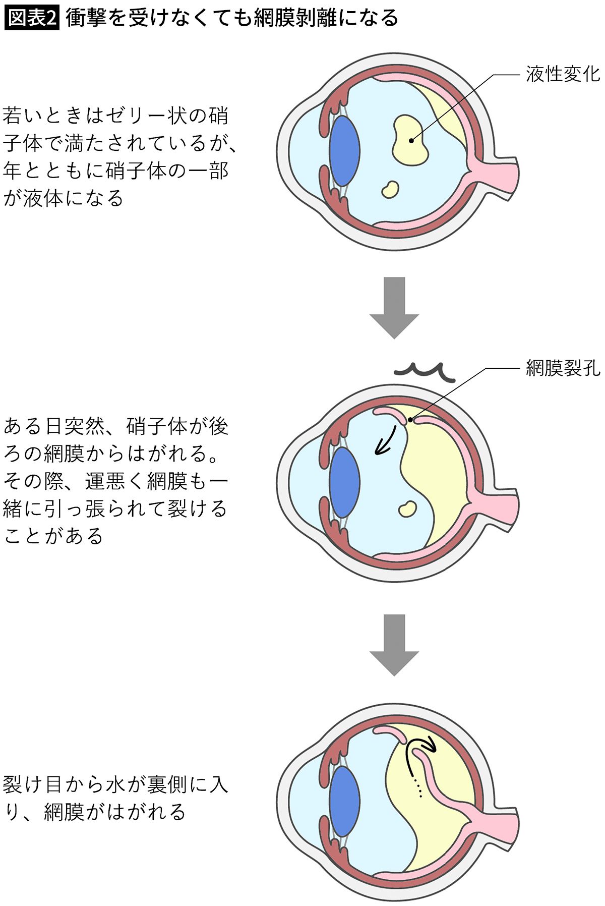 【図表2】衝撃を受けなくても網膜剝離になる