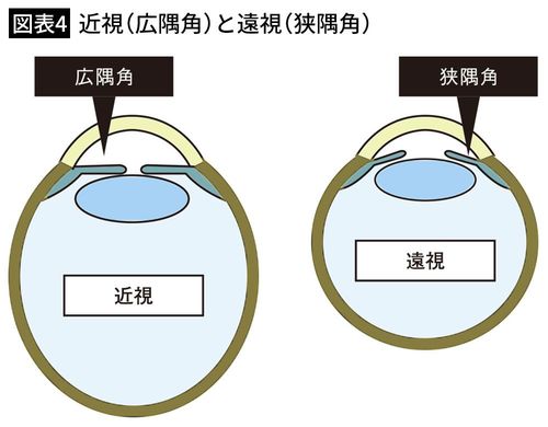 【図表4】近視（広隅角）と遠視（狭隅角）