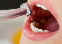 1本55万「歯インプラント治療費」全明細