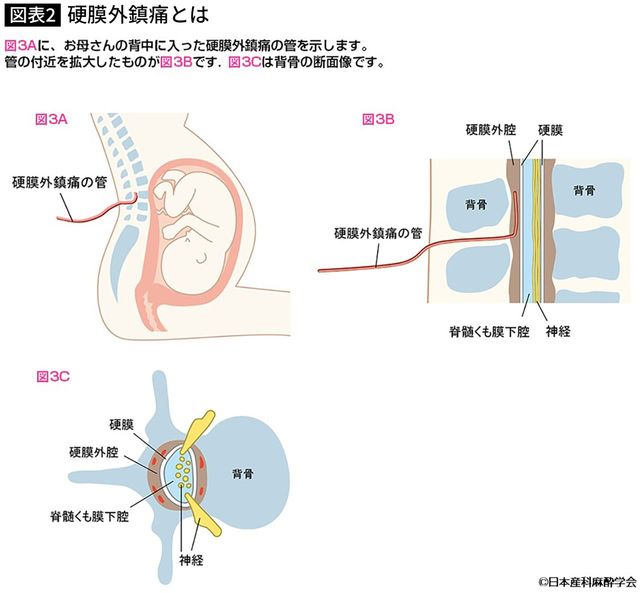 【図表】硬膜外鎮痛とは