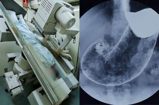 胃がんバリウム検査の撮影場面