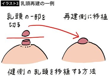 命が助かったのだから乳房がなくても仕方ない｣韓国で5割超の乳房再建率