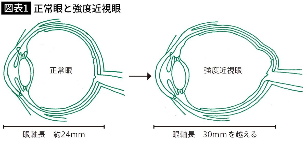 【図表1】正常眼と強度近視眼