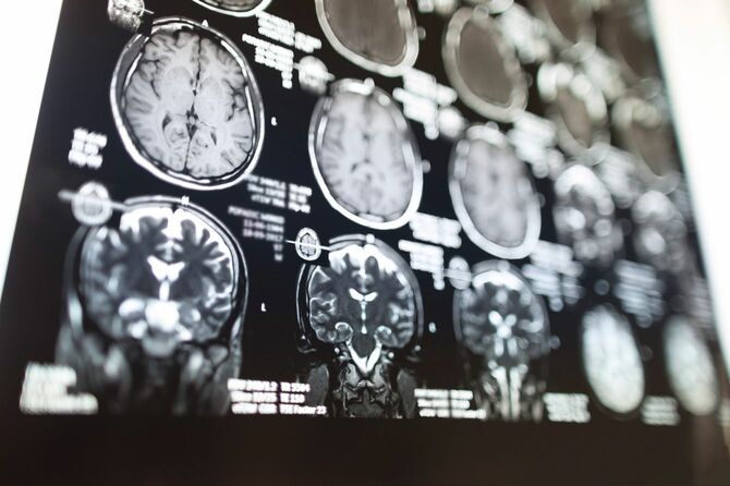脳のMRI写真