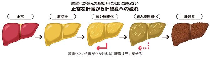 【図表】正常な肝臓から肝硬変への流れ