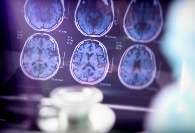 アルツハイマー型認知症診断でMRI画像を確認
