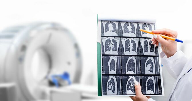 CTで撮影した患者の肺の断層撮影をチェックする人の手元