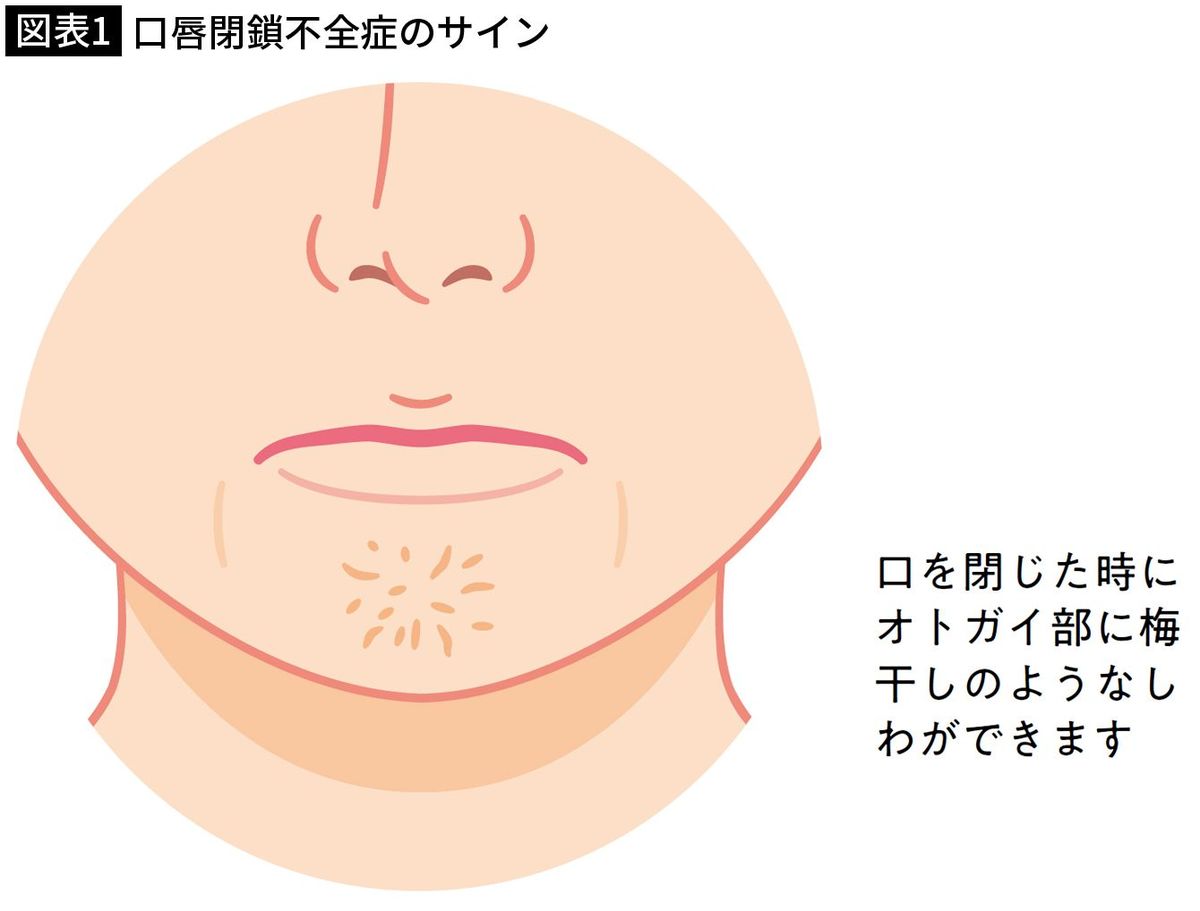 【図表1】口唇閉鎖不全症のサイン