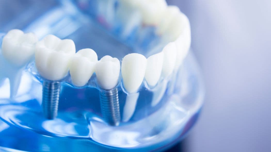 現役歯科医爆笑座談会｢荒稼ぎインプラント歯医者はなぜ､沖縄へ逃げたのか｣ 歯科医は医者じゃなくて大工だ!