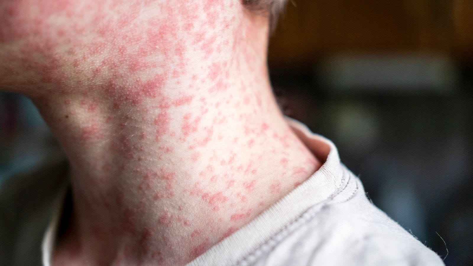 ほかの感染症に対する免疫を｢リセット｣する…世界で大流行中の麻疹の｢稀に死亡するだけじゃない｣恐ろしさ 感染力が高く､治療法はない