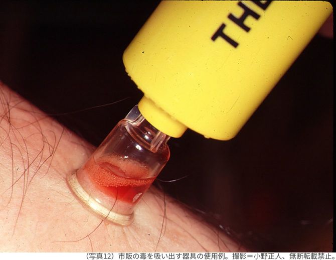 （写真12）市販の毒を吸い出す器具の使用例。撮影＝小野正人、無断転載禁止。
