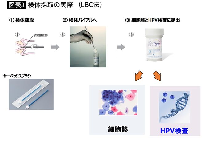 【図表3】検体採取の実際(LBC法)
