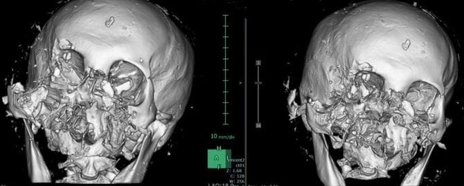 顔面（鼻を含む）が欠損した被害者の3D-CT像