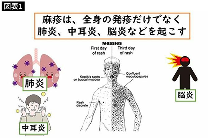 文献2から筆者作成・麻疹は全身の発疹だけでなく、肺炎、中耳炎、脳炎などを起こす