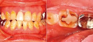 健康酢で歯の表面がドロドロに溶けた状態（左）。クエン酸をコーラで服用するのを繰り返していた患者の歯。詰め物が浮き出ているように見え、歯が大きく減っているのがわかる（右）。
