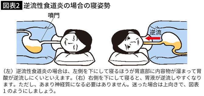 逆流性食道炎の場合の寝姿勢