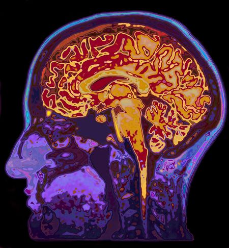 MRIの頭部を示す脳画像