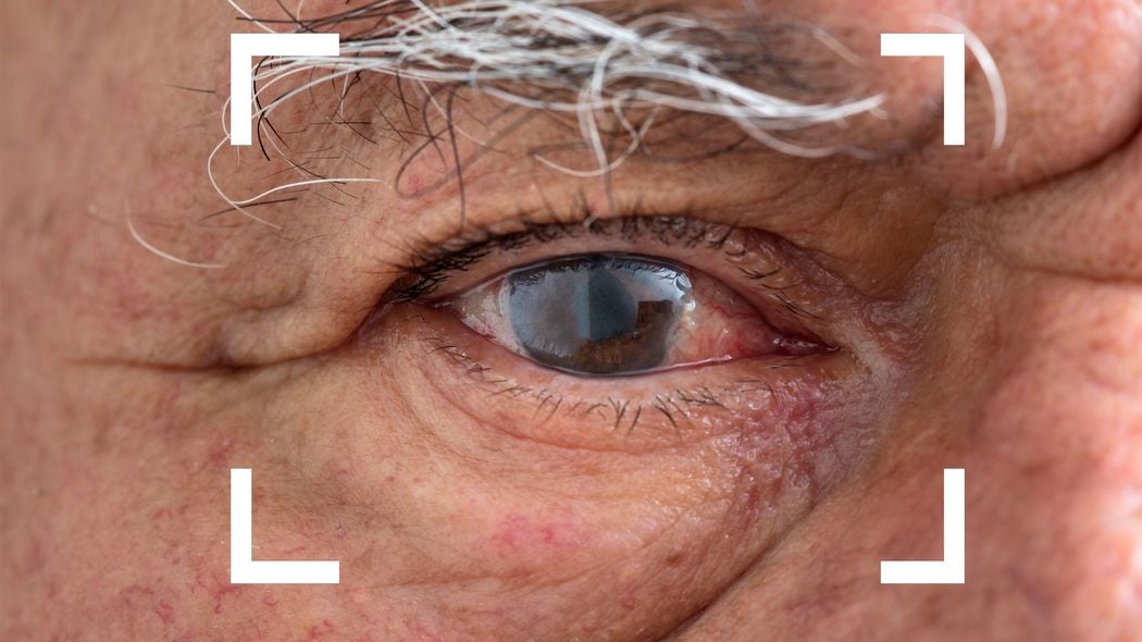 12万円の白内障手術が｢老人割引｣で93%オフに…高齢者に優しすぎる｢高額療養費制度｣は本当に続けられるのか 社会保険の財政がパンクしてしまう