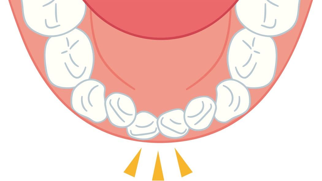 歯の矯正は10歳までに9割決まる…子供の一生を左右する｢上顎｣の成長に欠かせない"舌の位置" 子どもの成長期を利用すると､より小さな負担で歯並びを整えられる