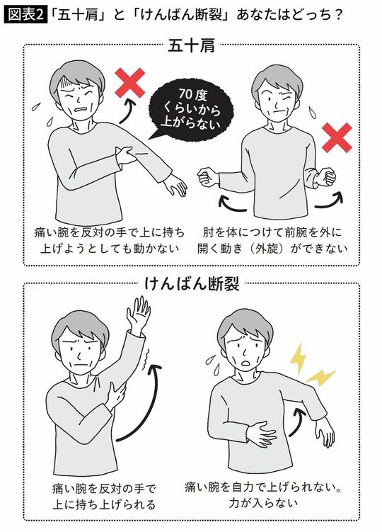 「五十肩」と「けんばん断裂」あなたはどっち？