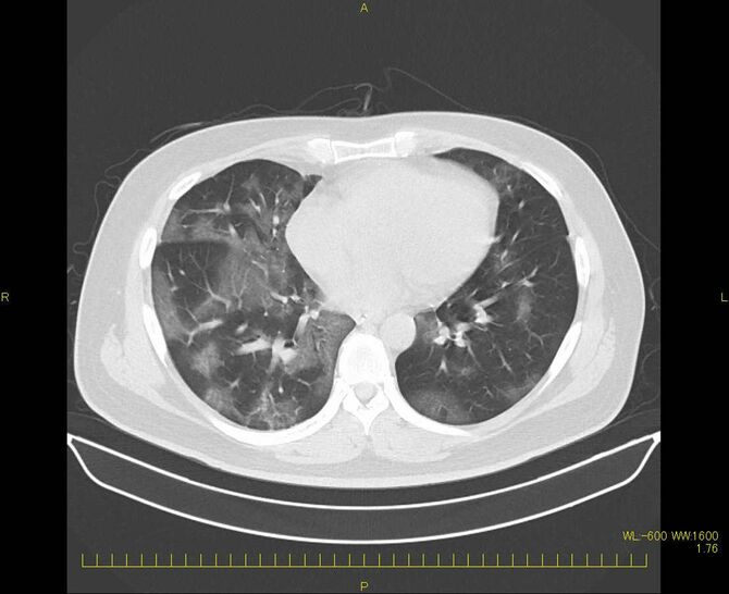 新型コロナに感染した外科医の肺CT画像