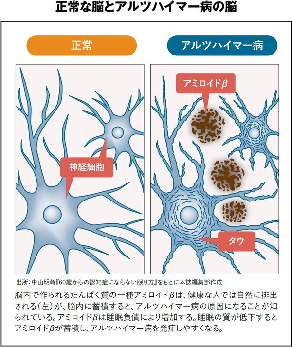 正常な脳とアルツハイマー病の脳