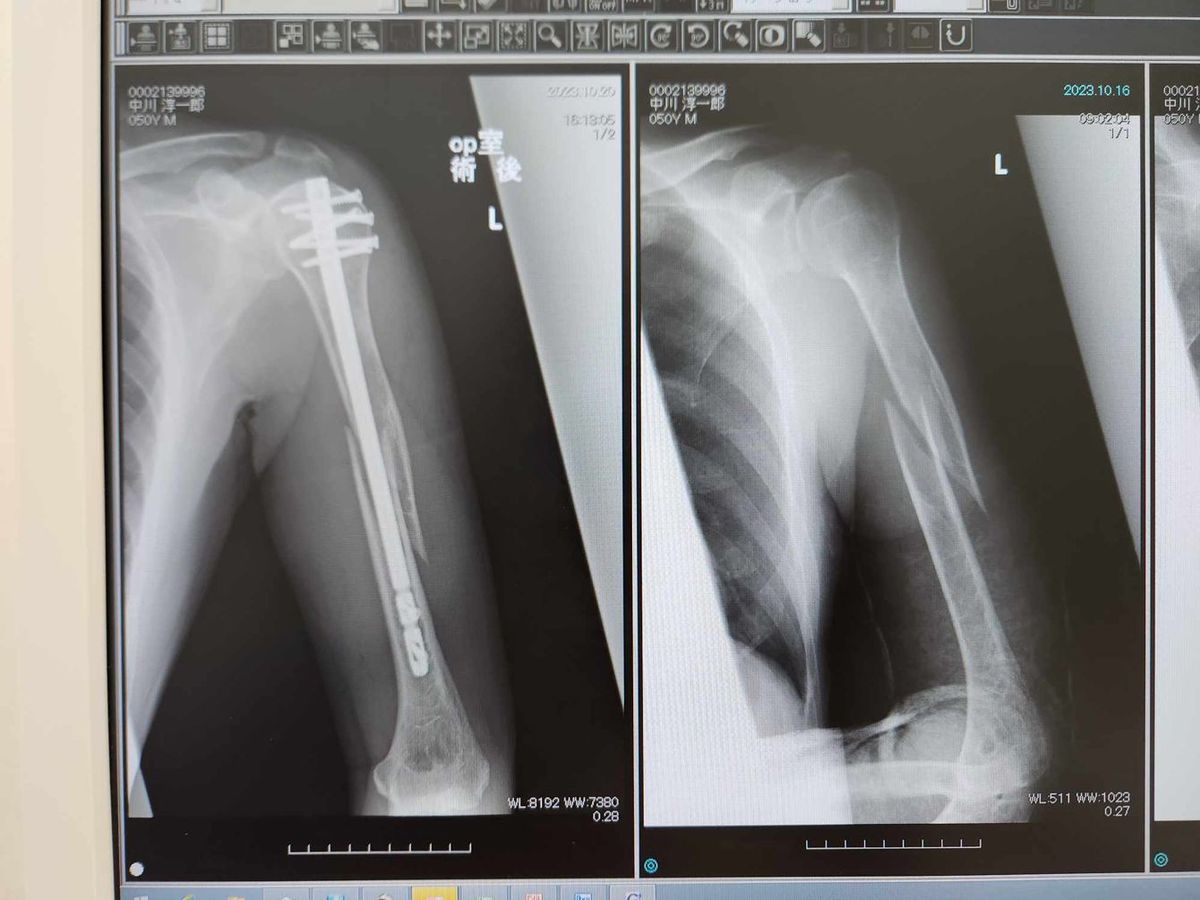 著者の左上腕部レントゲン写真。右が手術前、左が術後。