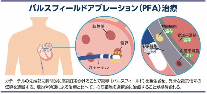 【図表】パルスフィールドアブレーション(PFA)治療