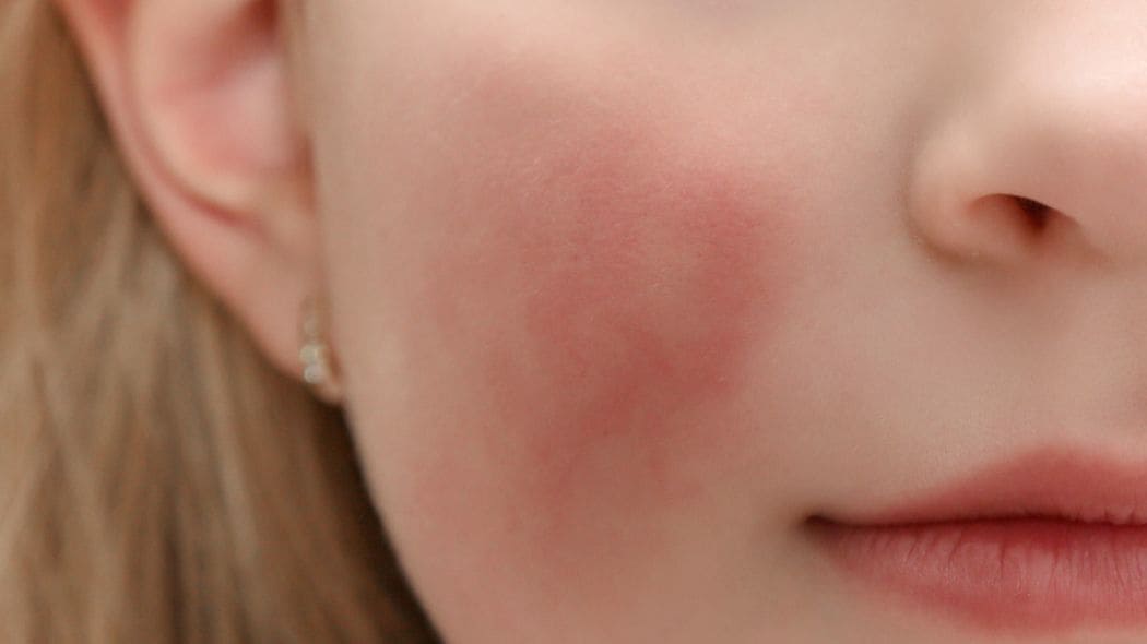 頬が赤く染まってから感染予防しても手遅れ…警報レベルで大流行中の｢リンゴ病｣その恐るべき特徴 妊婦､免疫不全などの人は特に要注意