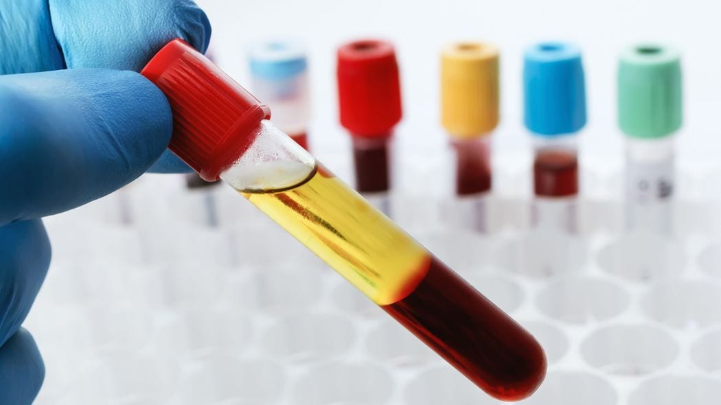 ｢血液型で病気リスクがこんなに違う｣O型に比べ脳卒中1.83倍､認知症1.82倍…という血液型とは何か【2023下半期BEST5】 O型は大量出血など大怪我の場合､死亡率が他の血液型の倍以上