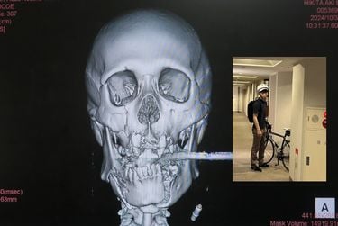 ベンツにはねられ､顔の下半分がグジャグジャに…自転車乗りの息子の命を