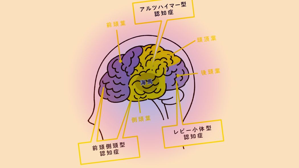 ｢認知症の原因は80以上ある｣まずは"敵"を知れ…認知症4タイプと"治る認知症"という知られざる存在 認知症高齢者数は推定600万人以上､前駆症状も同じくらい存在