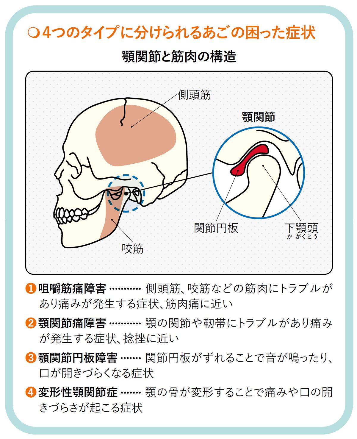 【図表】4つのタイプに分けられるあごの困った症状