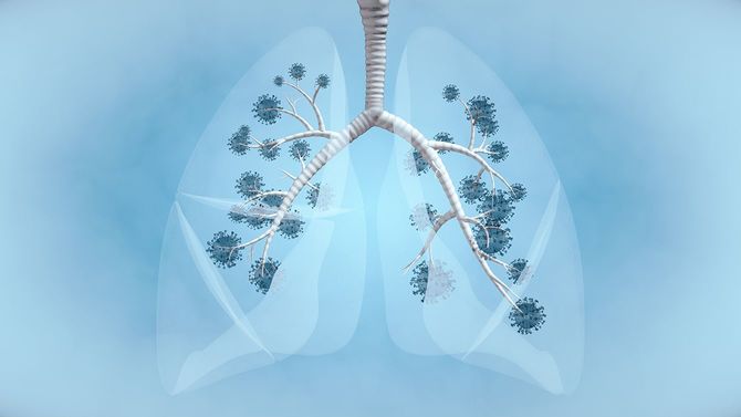 肺のパンデミック病
