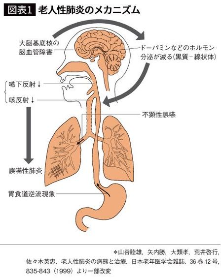 【図表1】老人性肺炎のメカニズム
