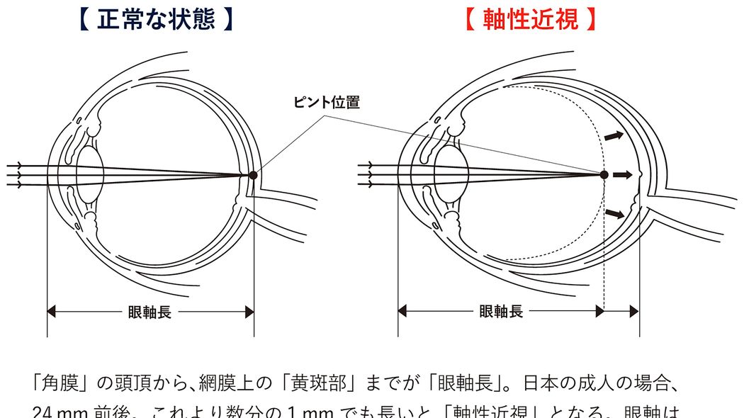 眼球が変形し､運転免許も取れない…スマホの見過ぎがもたらす｢近視￫社会的失明｣という巨大リスク 同じ視力でも｢眼軸長｣によってリスクが異なる
