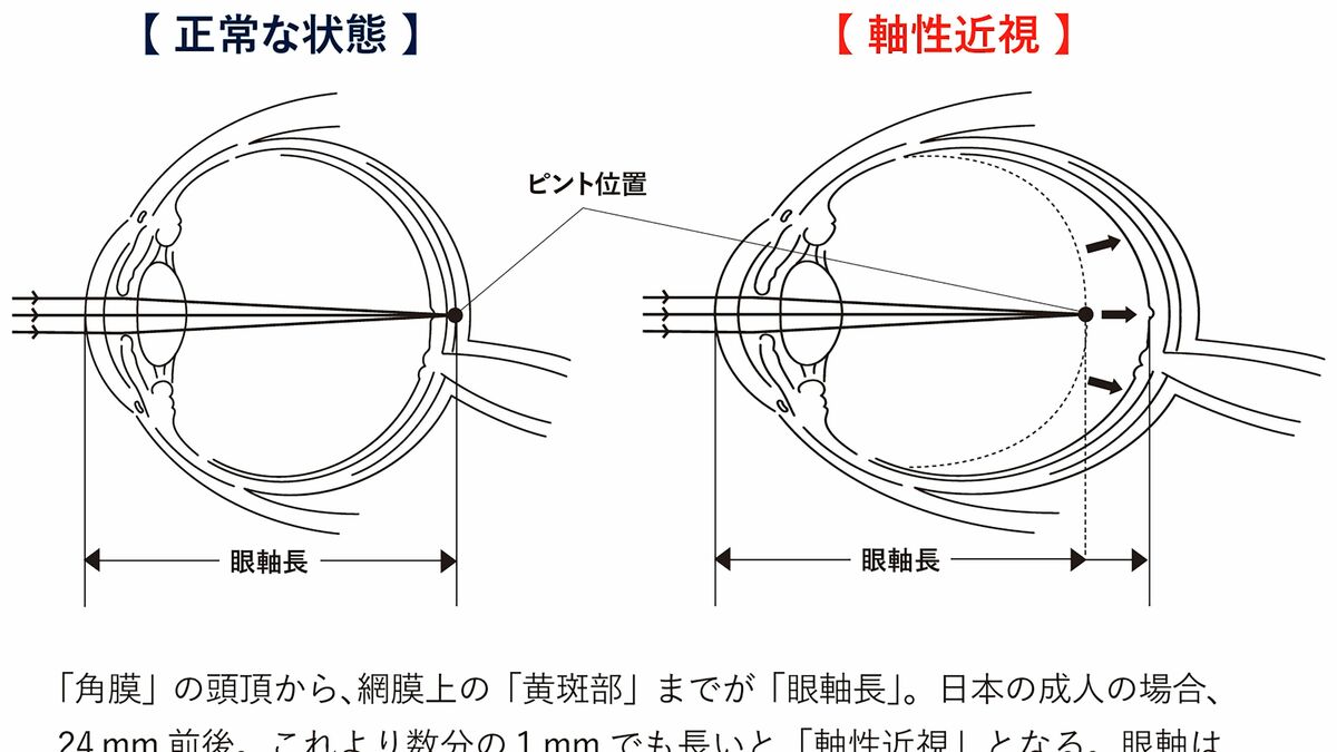近視 スマホ