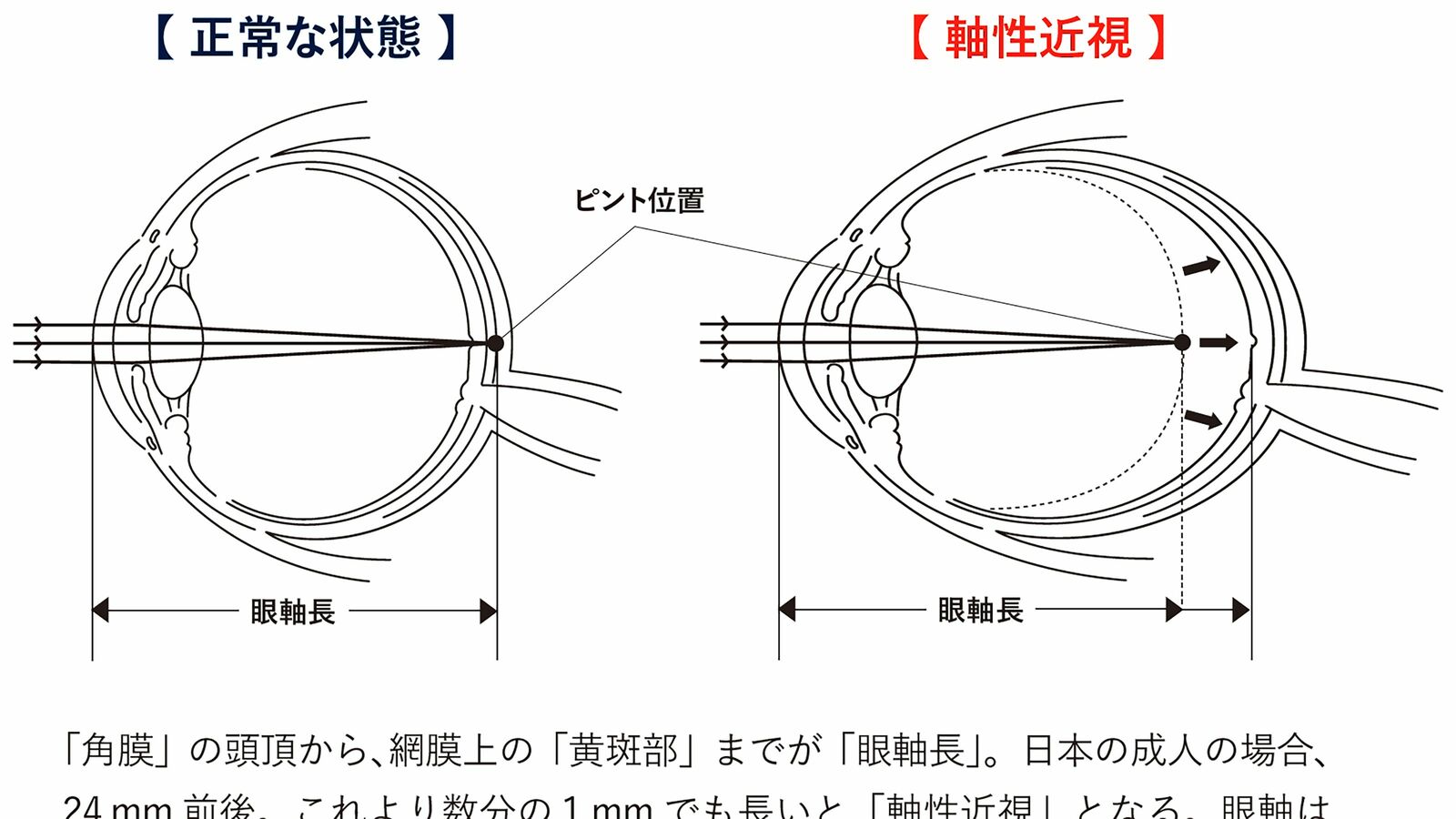 眼球が変形し､運転免許も取れない…スマホの見過ぎがもたらす｢近視￫社会的失明｣という巨大リスク 同じ視力でも｢眼軸長｣によってリスクが異なる