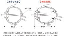 眼球が変形し､運転免許も取れない…スマホの見過ぎがもたらす｢近視￫社会的失明｣という巨大リスク