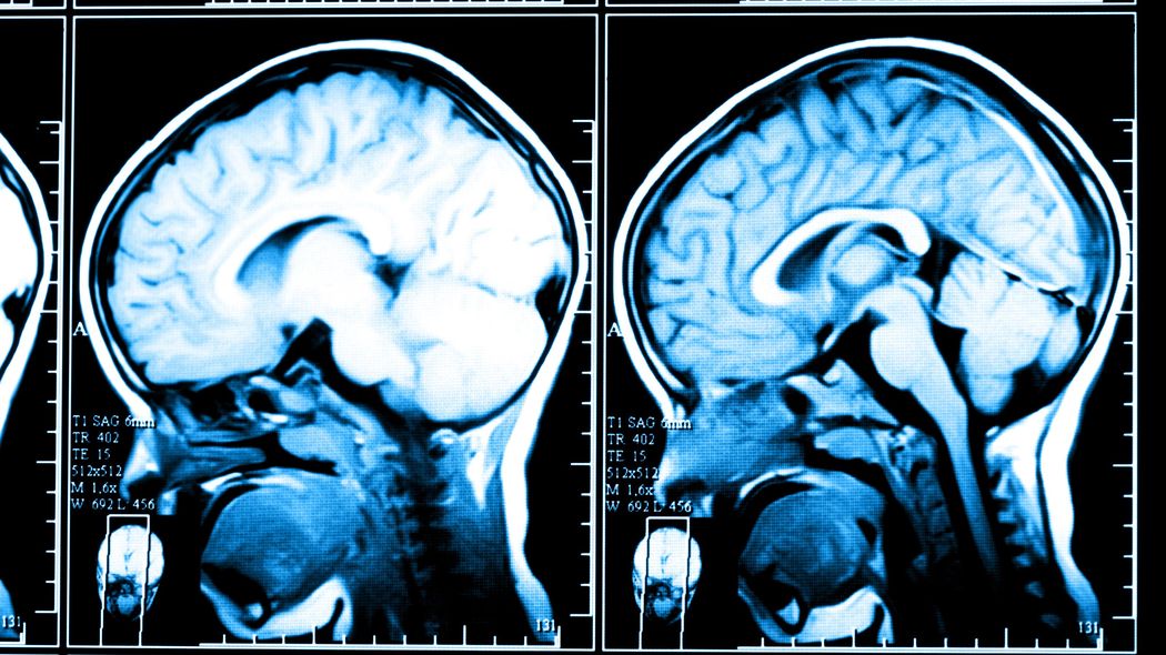 素人目でも脳の形が完全に変わった…認知症でも脳梗塞でもない不治の病の60代夫を支える薬剤師妻の深い愛情 並んで歩いていると急に姿が消え､地面に転がっていた