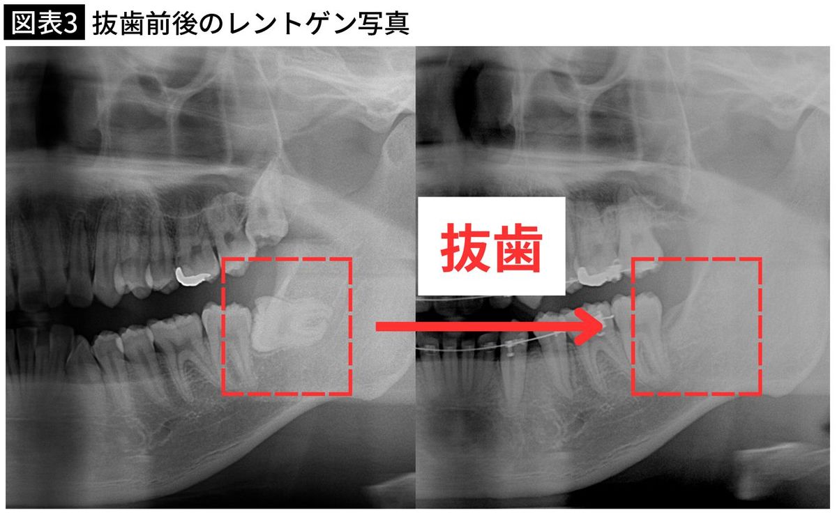 【図表3】抜歯前後のレントゲン写真