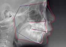 なぜ街の歯医者は「矯正」「インプラント」を勧めるのか