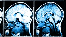 素人目でも脳の形が完全に変わった…認知症でも脳梗塞でもない不治の病の60代夫を支える薬剤師妻の深い愛情