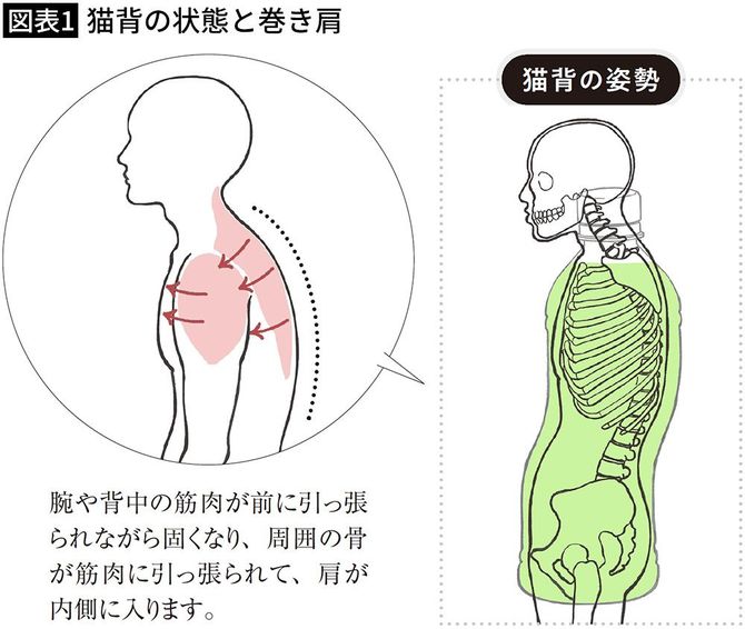 【図表1】猫背の状態と巻き肩